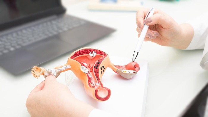 kanker serviks Gynecologist showing uterine structure on a uterus model. Uterus model on gynecologists desk close-up
