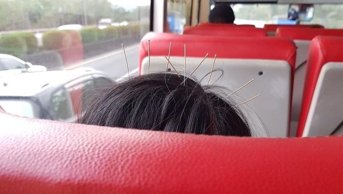 foto viral Foto viral wanita yang menaiki bis dengan 9 jarum akupunktur di kepalanya.