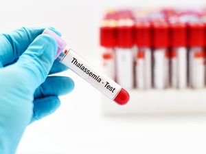 Viral Pasangan Terpaksa Batalkan Nikah Pasca Tahu Idap Thalassemia, Kondisi Apa Itu?