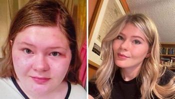 15-19 tahun. Saya ingin berterima kasih kepada Accutane (obat) dan kini sudah hilang 90 pounds (40kg). Foto: Boredpanda