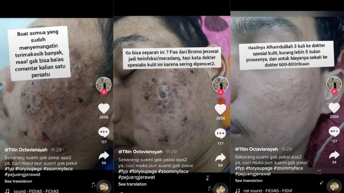 viral jerawat meradang viral jerawat meradang