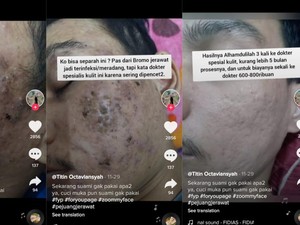 Hobi Pencetin Jerawat? Hati-hati, Dampaknya Bisa Seperti Ini