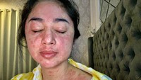 Dewi Perssik memperlihatkan wajah dan bagian tubuhnya yang muncul ruam merah. Foto: instagram