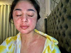 Ruam Kulit Muncul Hari ke-11, Dewi Perssik Ceritakan Rasanya Kena Gejala Corona