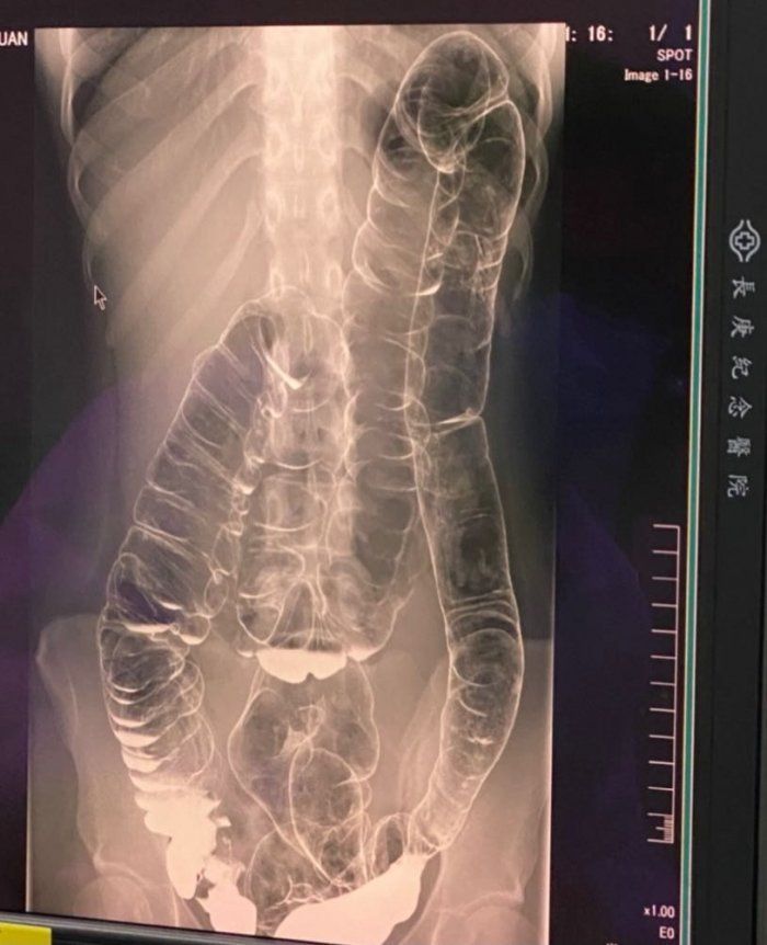 Hasil rontgen usus wanita yang sering mengalami sembelit.