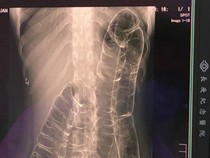 Hasil Rontgen Wanita Sembelit Kronis 23 Tahun, Kondisi Ususnya Bikin Kaget