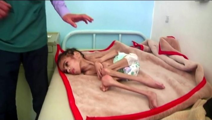Bocah 7 tahun di Yaman hanya miliki berat 7 kg (Screen shot video Reuters)