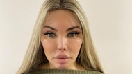 Transgender Operasi Hidung 10 Kali Demi Mirip Barbie, Nasibnya Jadi Begini