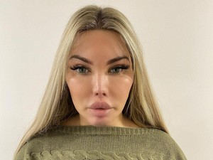 Transgender Operasi Hidung 10 Kali Demi Mirip Barbie, Nasibnya Jadi Begini