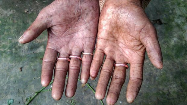 Kisah keluarga tanpa sidik jari, kondisi genetik langka yang membuat mereka sulit masuk ke negara lain