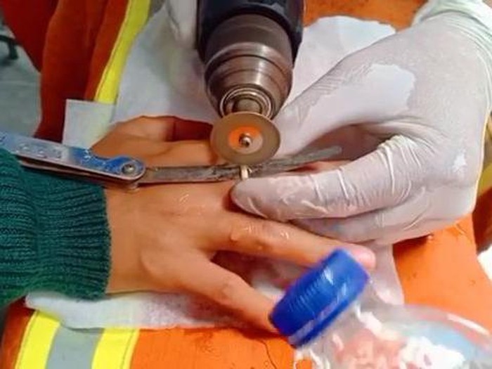Petugas pemadam kebakaran (damkar) Pemkot Surabaya tak hanya ahli memadamkan api. Namun masalah cincin yang nyangkut di jari warga juga bisa diatasi.