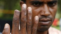 Seorang pria Rohingya menunjukan tangganya yang putus akibat kekejaman militer Myanmar di pengungsian mereka di Aceh (12/2/2009). Ulet Ifansasti / Getty Images