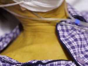 Sering Minum Alkohol Selama 30 Tahun, Tubuh Kakek Ini Berubah Kuning
