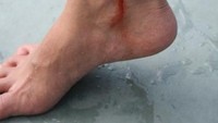 Akibat gigitan Pacet di kaki