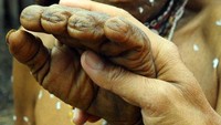Seorang nousa (wanita tua) menunjukkan jarinya yang hampir habis terpotong.