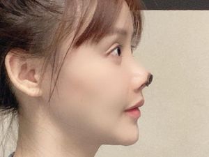Gegara Oplas Gagal, Hidung Aktris China Ini Menghitam dan Membusuk
