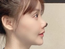 Gegara Oplas Gagal, Hidung Aktris China Ini Menghitam dan Membusuk