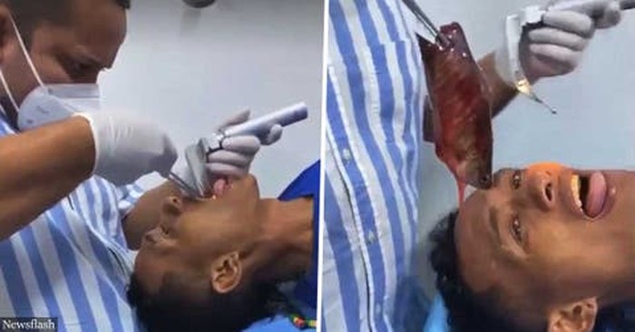 Duh! Ikan Sepanjang 43 Cm Nyangkut di Tenggorokan Pria Ini