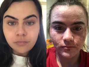 Wajah Wanita Ini Berakhir Rusak dan Bersisik Usai Pakai Krim Eczema