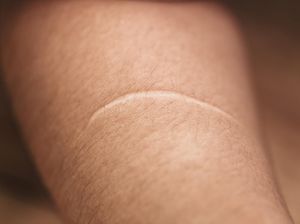 Codet hingga Pitak, Ini 7 Istilah Bekas Luka dalam KBBI