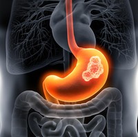 Mengenal Gastric Balloon, Cara Turunkan Berat Badan dengan Balon Tanpa Operasi