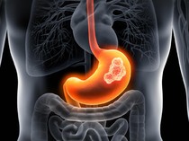 Wanita Idap Kanker Lambung Stadium 4, Gejalanya Sering Dikira GERD oleh Dokter