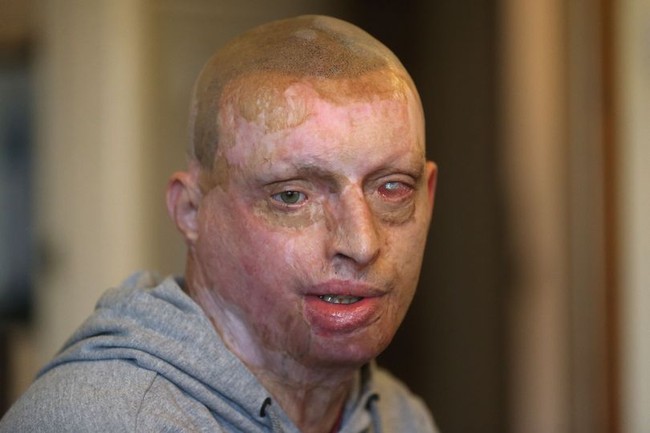 Daniel Rotariu tidak pernah menyangka bahwa hanya dalam satu malam hidupnya berubah dan mungkin akan menyisakan trauma seumur hidupnya karena ulah mantan kekasihnya. Daniel menjadi korban penyiraman air keras oleh mantan kekasihnya di 2016. Foto: dok. Nottingham Post