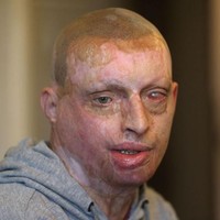 Daniel Rotariu tidak pernah menyangka bahwa hanya dalam satu malam hidupnya berubah dan mungkin akan menyisakan trauma seumur hidupnya karena ulah mantan kekasihnya. Daniel menjadi korban penyiraman air keras oleh mantan kekasihnya di 2016. Foto: dok. Nottingham Post