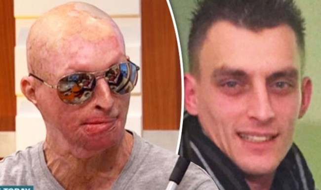 Inilah wajahnya sebelum dan sesudah jadi korban penyiraman air keras. Pria yang kehilangan satu matanya itu mengaku bahwa sampai hari ini masih mengingat-ingat kejadian buruk tersebut setiap harinya. Foto: Instagram