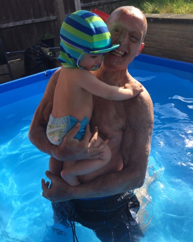 Daniel telah melakukan berbagai prosedur kecantikan untuk mengembalikan kulitnya yang sebelumnya meleleh. Dia telah melakukan cangkok kulit hingga melakukan prosedur meletakkan pigmen di kulit kepalanya sehingga tampak seperti rambut.  Foto: Instagram