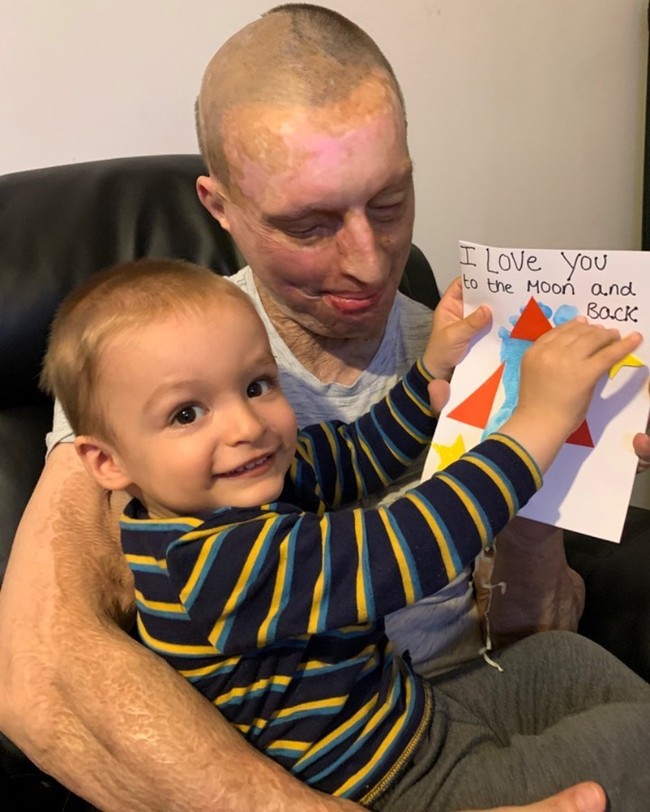 Lima tahun berlalu, beginilah kondisinya kini. Wajahnya tetap terlihat rusak. Meski begitu, kondisinya yang saat ini telah lebih baik karena Daniel melakukan berbagai operasi.  Foto: Instagram