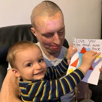 Lima tahun berlalu, beginilah kondisinya kini. Wajahnya tetap terlihat rusak. Meski begitu, kondisinya yang saat ini telah lebih baik karena Daniel melakukan berbagai operasi.  Foto: Instagram