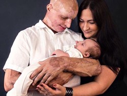 Potret Pria Berwajah Rusak karena Disiram Air Keras Oleh Mantan Kekasihnya