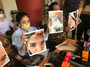 Nindy Ayunda Bongkar Bukti KDRT, Dijambak dan Dipukul Askara