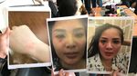 Nindy Ayunda Tunjukkan Bukti KDRT, Luka Lebam hingga Rambut Rontok