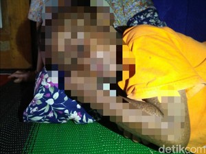 Idap Penyakit Langka, Bocah Sukabumi Dilarang Terpapar Sinar Matahari