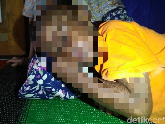 Bocah di Sukabumi mengidap penyakit langka hingga dilarang terpapar sinar matahari