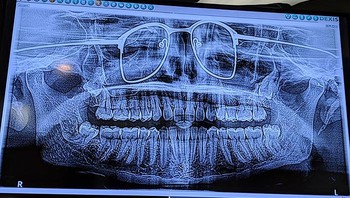 X-Ray panorama gigi. Foto: doc Bored Panda
