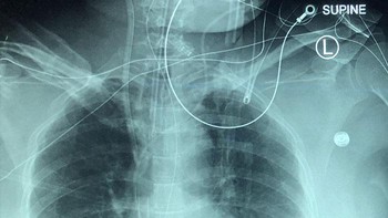 Ini adalah hasil X-Ray kondisi 5 hari Pneumonia Covid. CFoto: doc Bored Panda