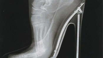 X-Ray kaki menggunakan sepatu stiletto. Foto: doc Bored Panda