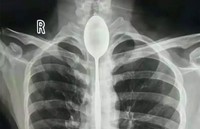 Foto X-Ray