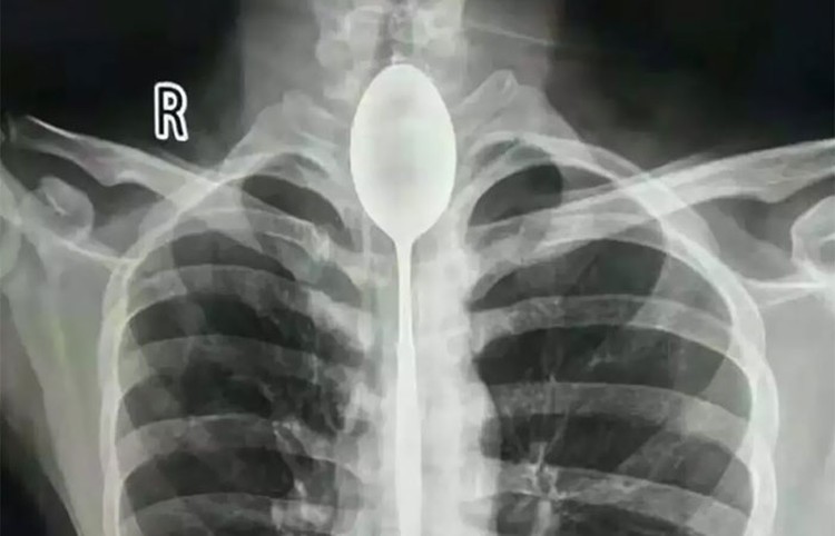 Foto X-Ray