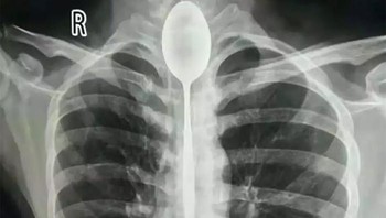 X-Ray seorang yang tertelan sendok. Foto: doc Bored Panda