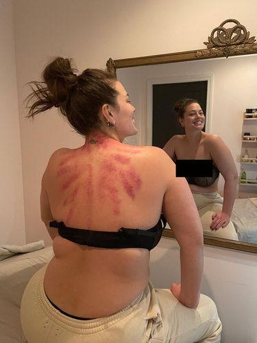 Ashley Graham pamer punggung merah-merah bekas kerokan.