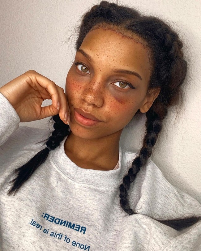 Ibu dua anak itu pun puas dengan dahinya yang mengecil 3 cm dari 8,5 cm menjadi 5,5 cm. Meski sukses mengubah sedikit penampilan tak dipungkiri jika operasi tersebut menimbulkan rasa sakit. Ia mengaku sempat tidak bisa menggerakkan alis dan dahinya terasa kebas. Hingga kini bekas operasi yang hampir berbiaya $7.000 (Rp 100 jutaan) itu masih terlihat. Foto: Instagram @camillacolbro