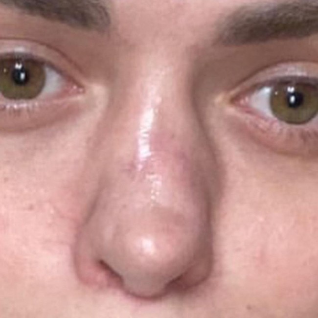 Korban operasi plastik? Ya! Aku mengutuk hari di mana aku dioperasi dokter bedah untuk pertama kalinya. Jika kamu adalah wanita dan sedang membaca ini, aku mohon padamu untuk mengerti apa yang tidak aku mengerti sebelumnya. Kamu tidak bisa menggunakan operasi plastik untuk meningkatkan percaya diri. Kamu tidak akan mencapai hasil yang diinginkan, ungkapnya. Foto: Instagram @nastenabalinskaya