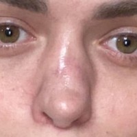 Korban operasi plastik? Ya! Aku mengutuk hari di mana aku dioperasi dokter bedah untuk pertama kalinya. Jika kamu adalah wanita dan sedang membaca ini, aku mohon padamu untuk mengerti apa yang tidak aku mengerti sebelumnya. Kamu tidak bisa menggunakan operasi plastik untuk meningkatkan percaya diri. Kamu tidak akan mencapai hasil yang diinginkan, ungkapnya. Foto: Instagram @nastenabalinskaya