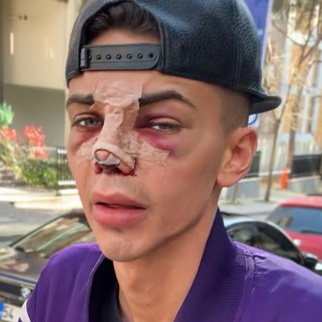 Di Instagramnya, pria 24 tahun itu tidak segan menunjukkan wajah lebamnya setelah operasi plastik. Seperti di foto ini, Levi menunjukkan wajahnya usai rhinoplasty atau operasi plastik hidung.  Foto: dok. Instagram