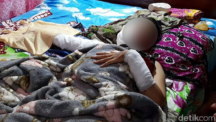 Siswi SMK di Brebes, Jawa Tengah, menjadi korban penyiraman cairan misterius yang menyebabkan kulit wajah, tangan, kaki dan dadanya terbakar.