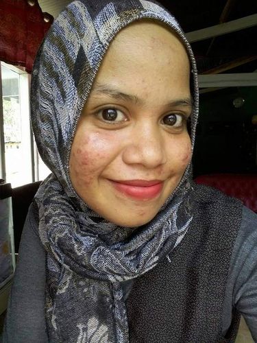 Kisah Saruni yang menjalani perawatan di klinik kecantikan abal-abal. Kisah Saruni yang menjalani perawatan di klinik kecantikan abal-abal.